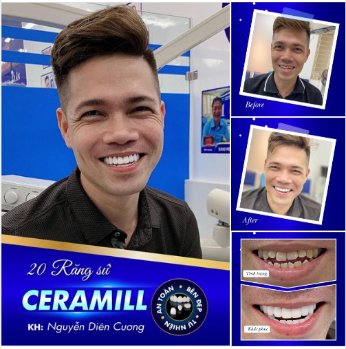Feedback của anh Diên Cương sau khi thực hiện bọc 20 răng sứ Ceramill tại Nha khoa thẩm mỹ Sunshine