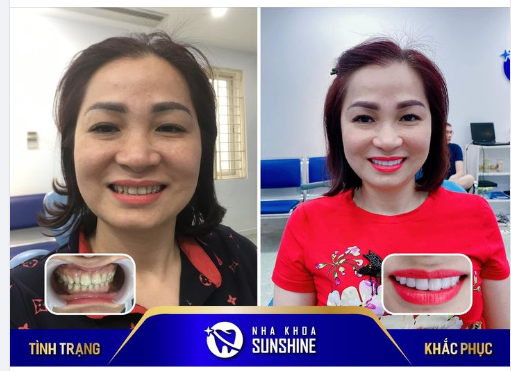 FEEDBACK SIÊU SỊN ĐẾN TỪ CHỊ KHÁCH HÀNG VỪA THỰC HIỆN XONG DỊCH VỤ BỌC RĂNG SỨ TẠI NHA KHOA THẨM MỸ SUNSHINE.