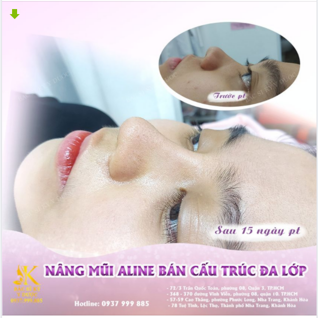 GƯƠNG MẶT THON GỌN HƠN SAU KHI NÂNG MŨI