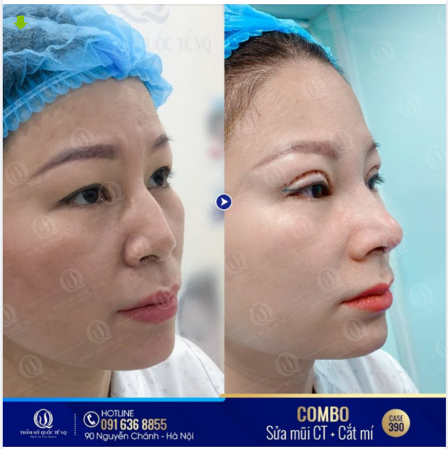 HÌNH ẢNH CHÂN THẬT NHẤT TỪ PHÒNG PHẪU THUẬT VQ
