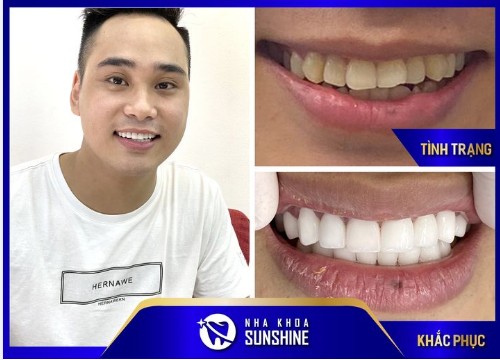 HT SMILE KHẲNG ĐỊNH NỤ CƯỜI LỊCH LÃM CHO CÁC QUÝ ÔNG
