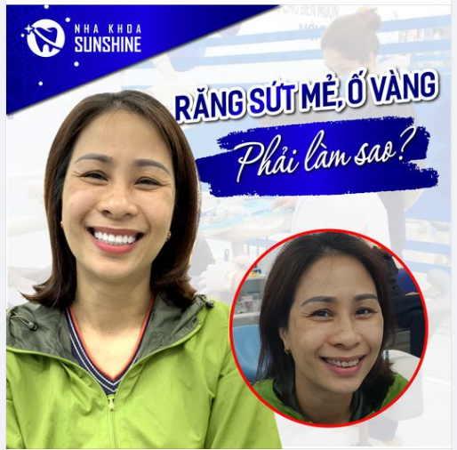 KHẮC PHỤC TÌNH TRẠNG RĂNG BỊ SỨT MẺ, Ố VÀNG TẠI NHA KHOA THẨM MỸ SUNSHINE