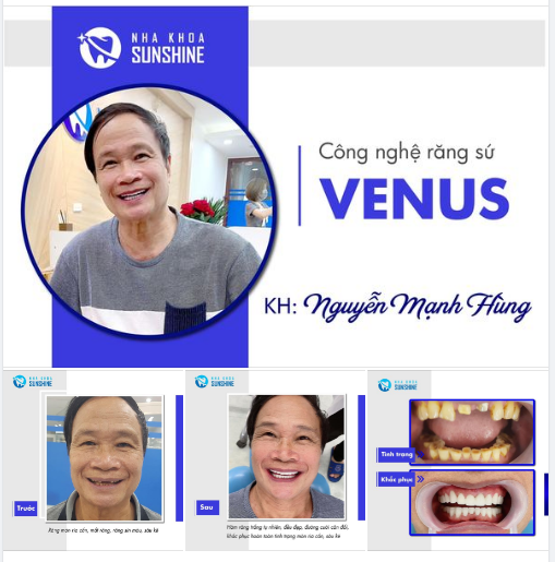 KHÔNG CÒN CHÚT KHUYẾT ĐIỂM TRÊN RĂNG CHỈ SAU 2 LẦN HẸN