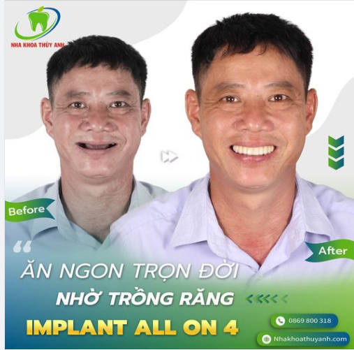 MẤT RĂNG TOÀN HÀM - TRỒNG LẠI RĂNG MỚI VỚI HÀM ALL ON 4