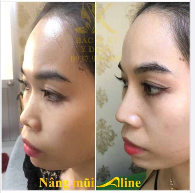 NÂNG MŨI “ALINE” HOT TREND NĂM 2021