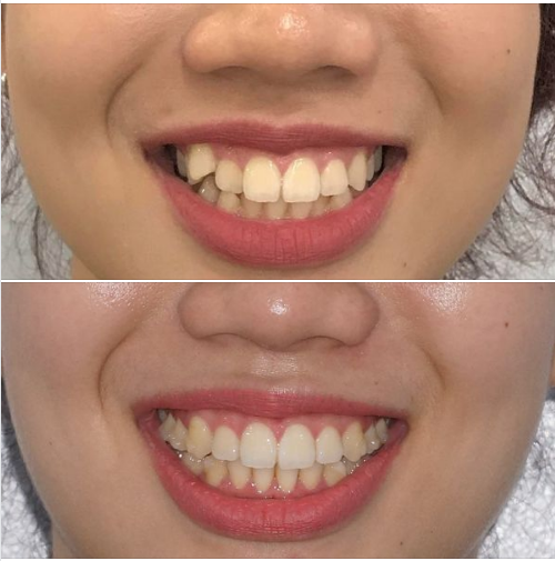 Nhiều trường hợp bác sĩ niềng răng sẽ đề nghị bạn nhổ răng nếu điều trị bằng mắc cài.