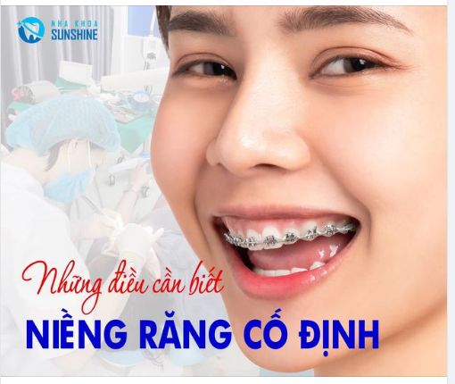 NHỮNG ĐIỀU CẦN BIẾT KHI NIỀNG RĂNG CỐ ĐỊNH