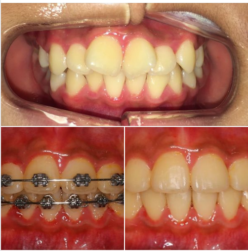 Niềng răng dựa vào sự phát triển của trẻ em là gì