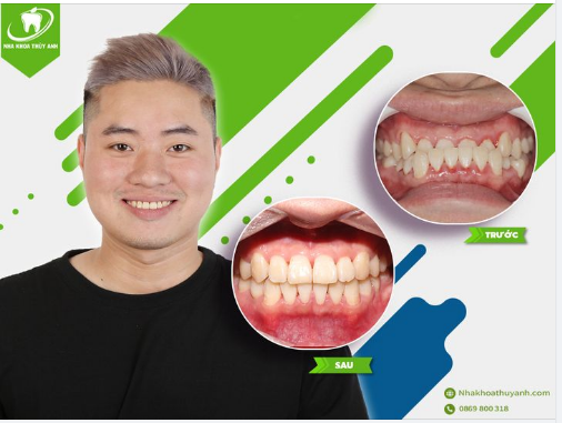 NIỀNG RĂNG HÔM NAY HẾT NGAY CẮN NGƯỢC