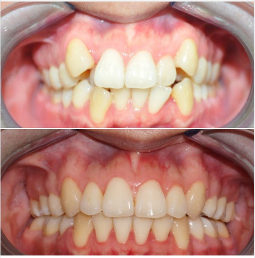 Niềng răng như thế nào để đẹp và bền vững