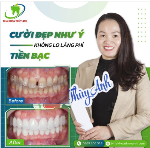 RĂNG NHIỄM MÀU, CÓ KHE THƯA - THẨM MỸ RĂNG SỨ GIÚP BẠN TỰ TIN HƠN