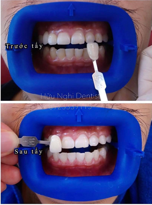 RĂNG TRẮNG SÁNG NỤ CƯỜI TƯƠI XINH
