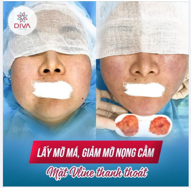 SAU LẤY MỠ MÁ, GIẢM MỠ NỌNG CẰM - GƯƠNG MẶT NHẸ NHÀNG, THON GỌN