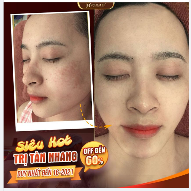 SIÊU HOT - ​​​​​​​ TRỊ TÀN NHANG OFF ĐẾN 60% CHỈ 3 TRIỆU