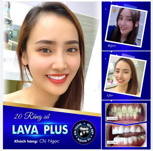 SIÊU PHẨM 20 RĂNG SỨ LAVA PLUS