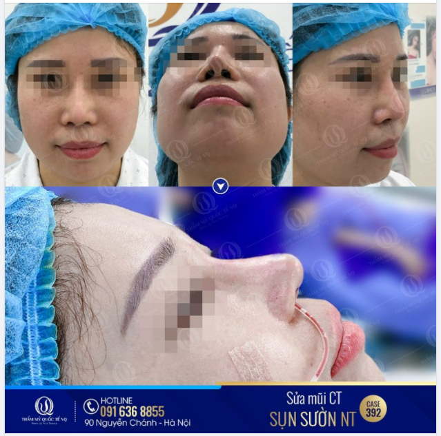 SỬA MŨI CẤU TRÚC SỤN SƯỜN NHÂN TẠO - PHƯƠNG PHÁP SỬA MŨI ĐỘC QUYỀN TẠI VQ