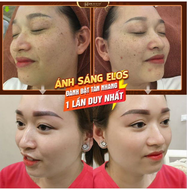 Tại sao da dẻ của NGƯỜI TA đẹp từ trong ra ngoài Còn của TÔI tàn nhang, nám mảng, sạm từ trong ra Da