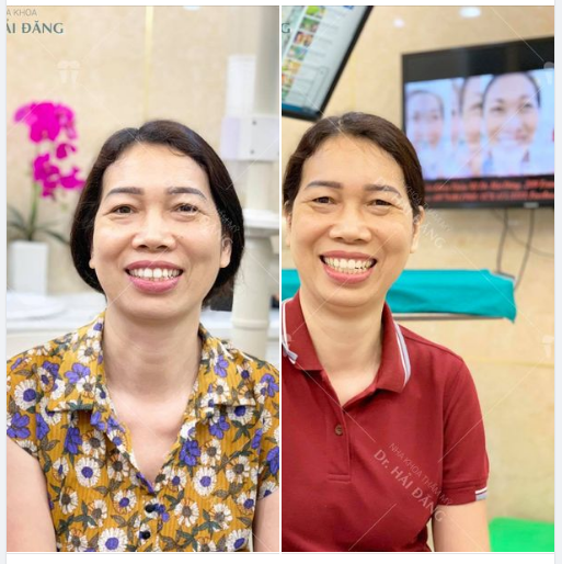 TẠM BIỆT HÀM RĂNG KHẤP KHỂNH - RĂNG THƯA