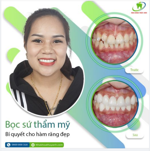 THẨM MỸ RĂNG SỨ GIÚP THAY ĐỔI DIỆN MẠO HÀM RĂNG