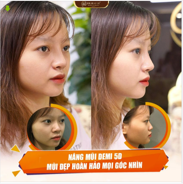 THỜI 4.0 CÔ GÁI NÀO CŨNG MUỐN MŨI CAO SANG