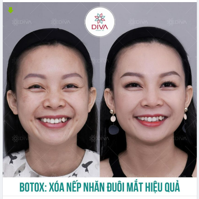 TIÊM BOTOX XÓA NẾP NHĂN ĐUÔI MẮT - TRẺ HÓA GƯƠNG MẶT