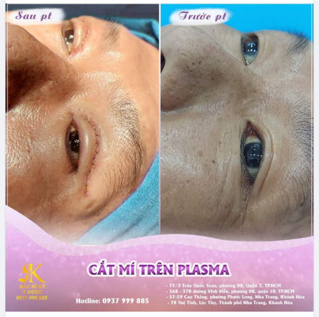 TÌM LẠI GIÁ TRỊ CỦA MỘT ĐÔI MẮT ĐẸP