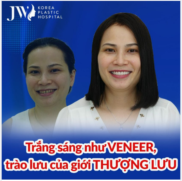 Trắng sáng như VENEER, trào lưu của giới THƯỢNG LƯU