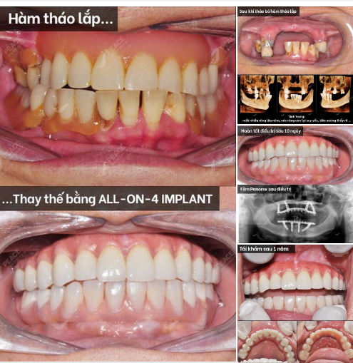 Trồng răng Implant toàn hàm với kỹ thuật All-on-4 (Implant Dentium - made in USA), phục hình tức thì hàm Hybrid Denture.