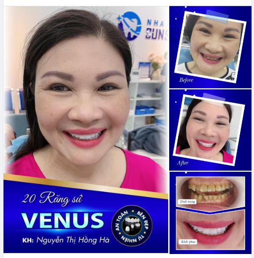 TỰ TIN KHOE NỤ CƯỜI TOẢ NẮNG CÙNG 20 RĂNG SỨ VENUS
