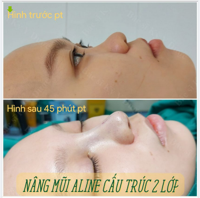 Bạn khách hàng nâng mũi Aline cấu trúc đa lớp
