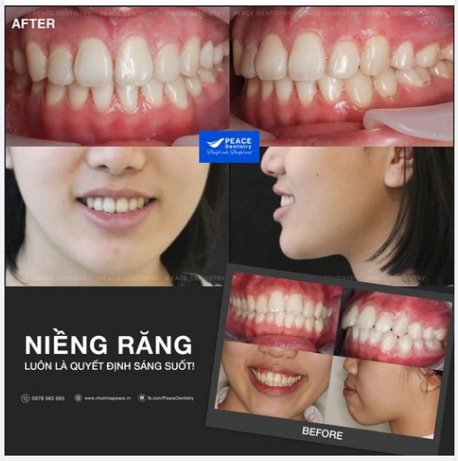 Ca lâm sàng niềng răng hô răng xương ổ 2 hàm, tháo mắc cài sau gần 2 năm