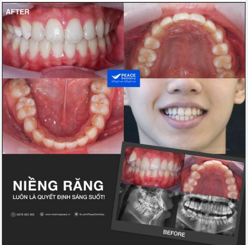 Ca lâm sàng niềng răng mắc cài sứ, hoàn thành trong 20 tháng