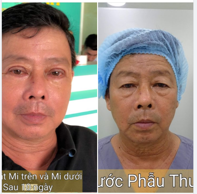 CẮT MÍ TRÊN VÀ DƯỚI PLASMA