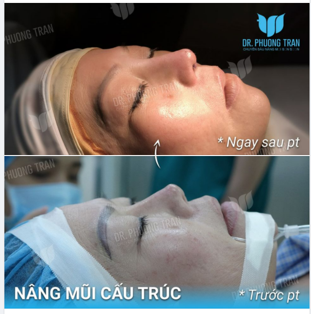 PHƯƠNG PHÁP TỐI ƯU NHẤT VỀ THẨM MỸ VÀ CHI PHÍ ĐỐI VỚI NHỮNG CHIẾC MŨI ĐÃ CÓ ĐẦU MŨI ĐẸP