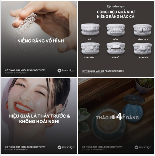 Invisalign sử dụng một loạt các khay niềng răng trong suốt “smart trays” để di chuyển răng của bạn một cách thông minh.
