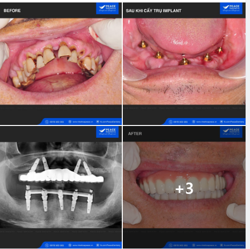 Không chỉ vậy, với All-on-4 Implant chúng ta chỉ mất từ 10 -14 ngày đã có thể ăn nhai với hàm răng mới.