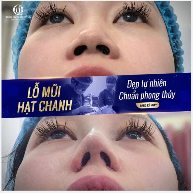 LỖ MŨI HẠT CHANH CAO SANG - TÀI LỘC