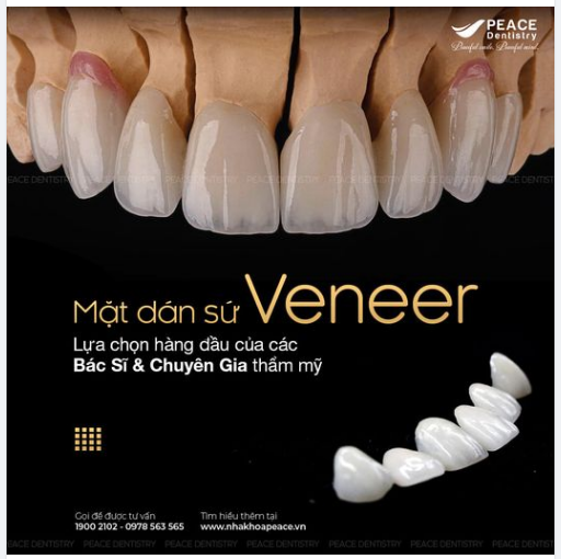 MẶT DÁN SỨ VENEER - SỰ LỰA CHỌN HÀNG ĐẦU CỦA CÁC BÁC SĨ & CHUYÊN GIA THẨM MỸ