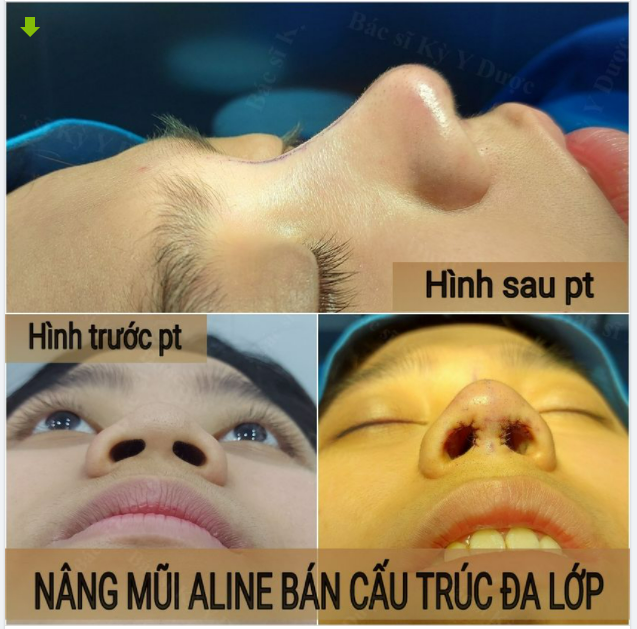 Nâng mũi Aline bán cấu trúc sụn tai đa lớp tại Bác Sĩ Kỳ Y Dược