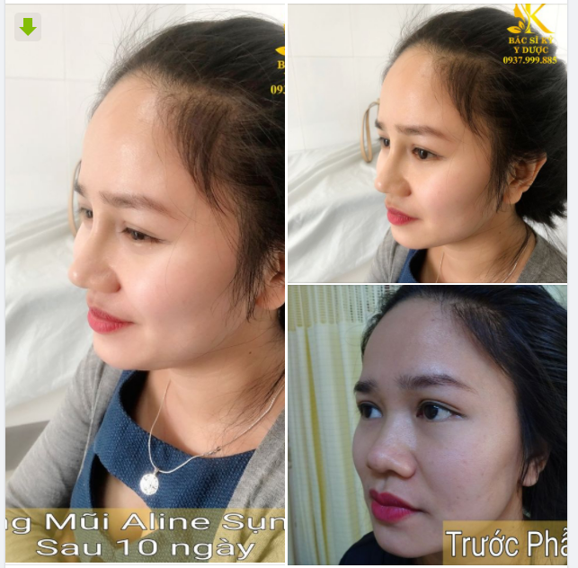 Nâng mũi sụn tai tại Bác Sĩ Kỳ Y Dược