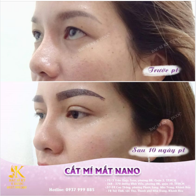 NẾU XINH ĐẸP LÀ ĐƯỢC LỰA CHỌN, HÃY LỰA CHỌN CẮT MÍ MẮT NANO ĐỂ CÓ ĐÔI MẮT LONG LANH