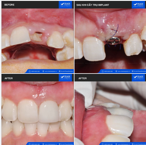NHỔ CHÂN RĂNG & CẤY GHÉP IMPLANT TỨC THÌ với các trường hợp chỉ còn chân răng