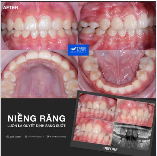 NIỀNG RĂNG CÓ THỂ NHANH HƠN BẠN NGHĨ RẤT NHIỀU NẾU...