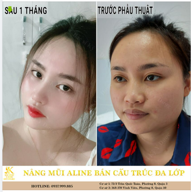 TẠM BIỆT DÁNG MŨI TẸT, THẤP - TẠO GƯƠNG MẶT THANH TÚ RẠNG NGỜI.