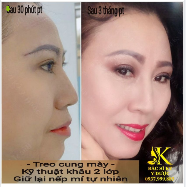 Treo cung mày- Kỹ thuật khâu hai lớp độc quyền