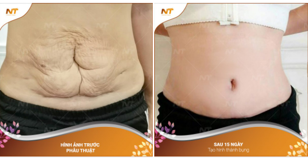 Những trường hợp tạo hình thành bụng