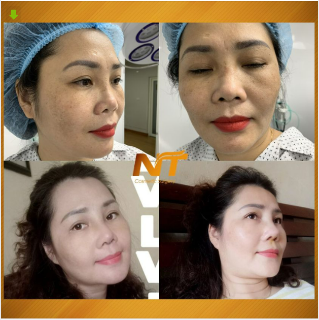 NGUYÊN NHÂN MŨI HỎNG SAU PHẪU THUẬT