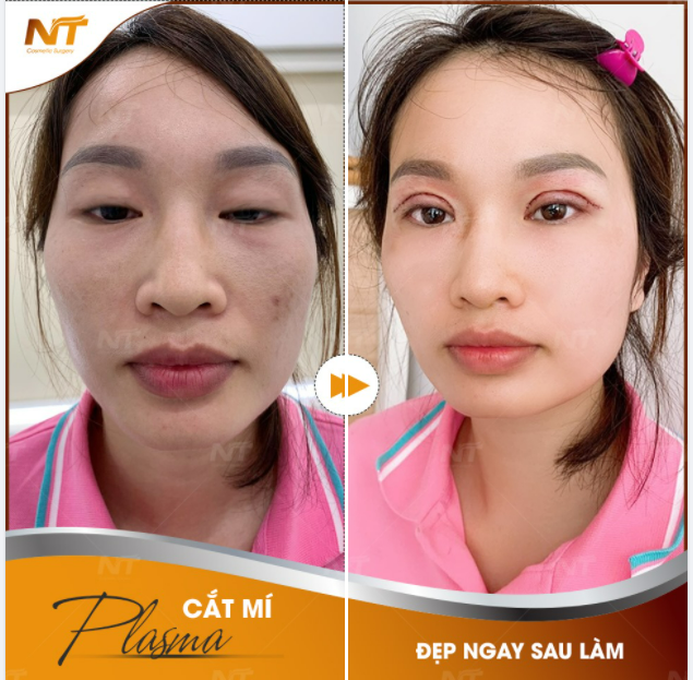 3 LƯU Ý VÀNG SAU KHI THỰC HIỆN CẮT MÍ MẮT