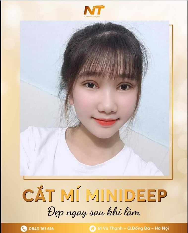 NẾP MÍ vào form SIÊU NÉT, SIÊU ĐẸP sau 7 ngày Cắt mí tại Dr Ngọc Trung. Chị em team "Một mí" thì đăng kí ngay tại đây để được tư vấn MIỄN PHÍ nhé.