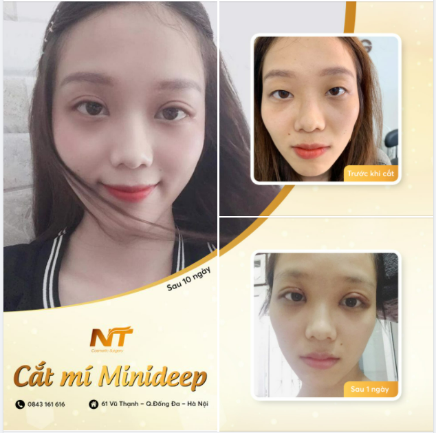​​​​​​​ CẮT MÍ MINIDEEP - ĐẸP NGAY SAU KHI LÀM